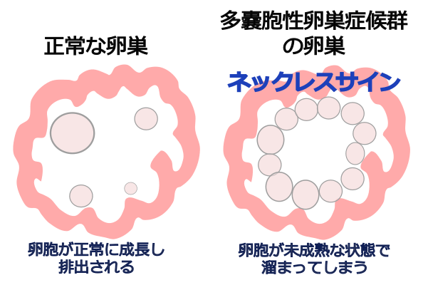 pcosネックレスサイン