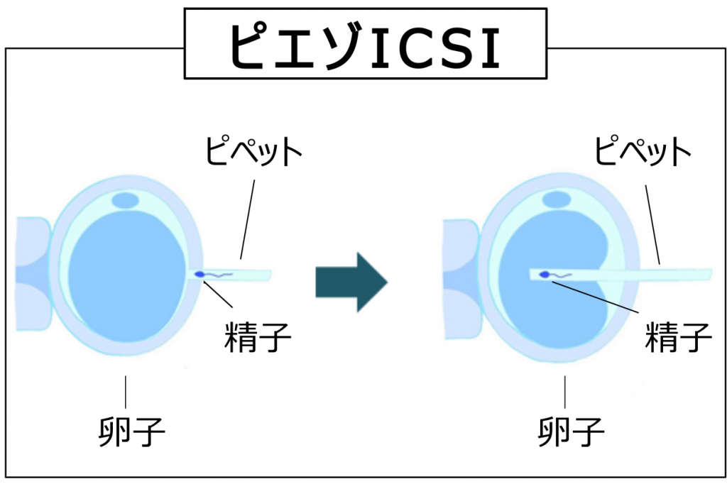 顕微授精ピエゾICSI